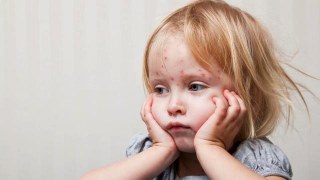 Більше 7000 львівських дітей отримали щеплення від кору